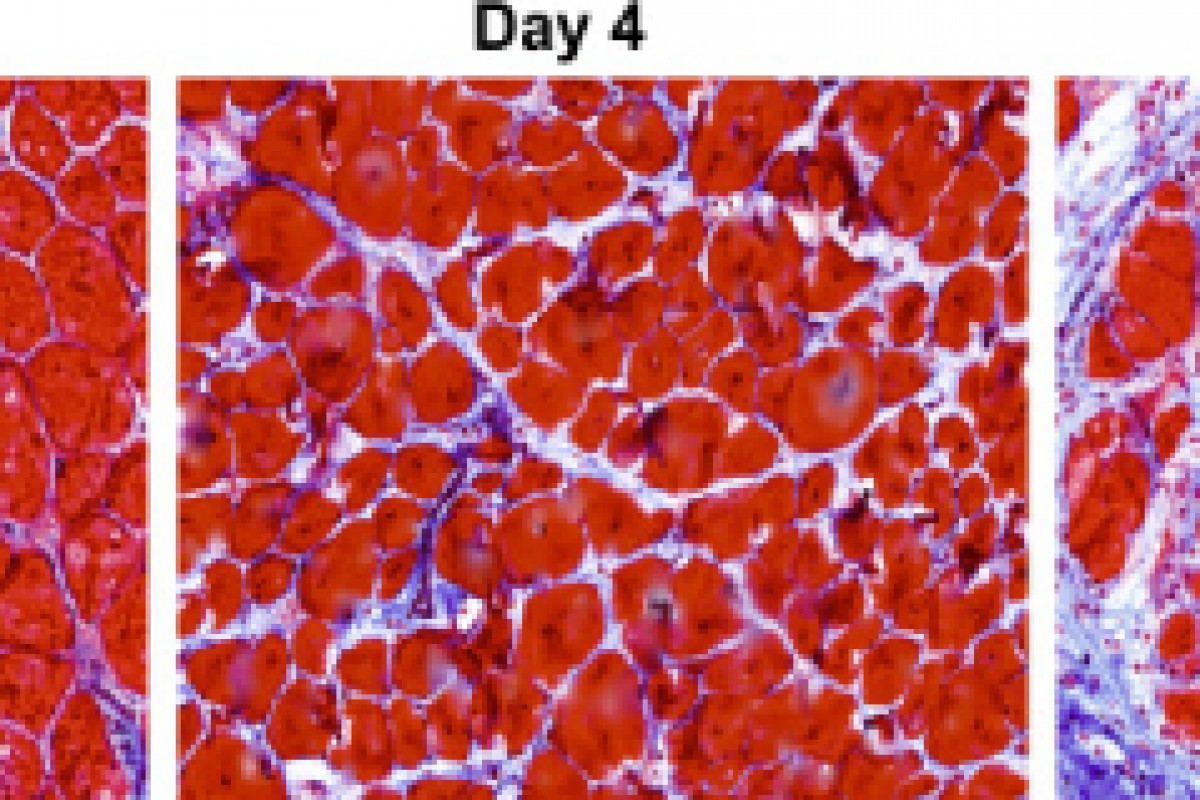 out-of-step muscle cells launch fibrosis development in duchenne