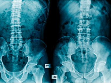 Scoliosis treatment FCMD