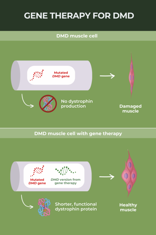 Infographic about gene therapy for DMD