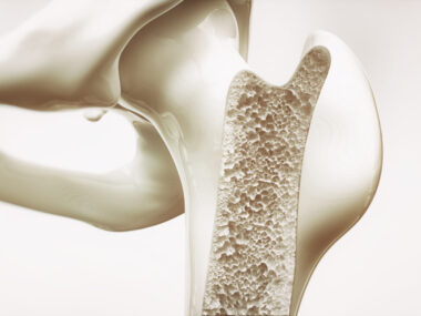illustration of what osteoporosis in bones looks like