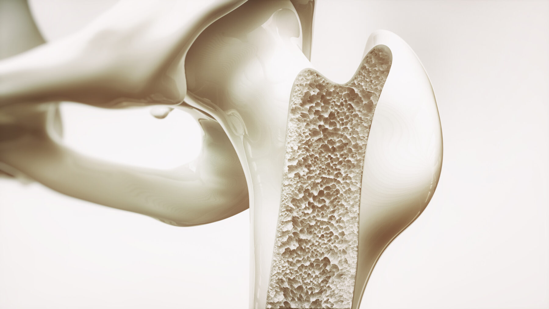 illustration of what osteoporosis in bones looks like